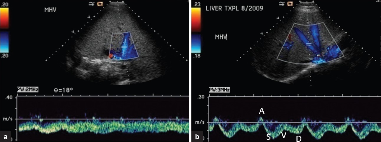 (a) Orthotopic hepatic transplant on post-operative day 5. Spectral Doppler reveals dampened hepatic vein waveform. (b) Same patient one month after surgery with spectral Doppler showing normal triphasic hepatic venous flow.