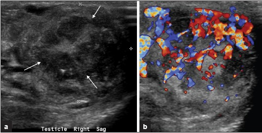 a) Right paratesticular gray-scale ultrasound of the scrotum in longitudinal plane demonstrates a well-defined solid paratesticular mass with spoke-wheel appearance (arrows). (b) Corresponding color flow Doppler image demonstrates increased internal vascularity.