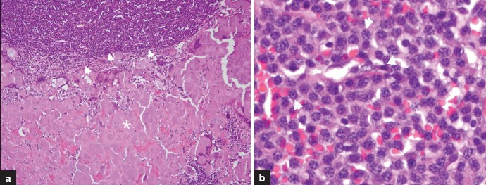 (a) Hematoxylin and eosin stain (100× original magnification) demonstrates amyloid deposition (asterisk) with tumoral cell infiltration (arrowheads). (b) Hematoxylin and eosin stain (400× original magnification) of the tumoral infiltration area reveals typical clock face pattern nuclei (arrowheads) in plasma cells diagnostic of plasmacytoma.