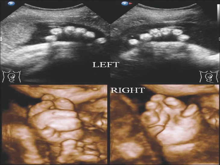 Prenatal 2D and 3D ultrasound image showing right synpolydactyly with seven fingers and left hexadactyly.