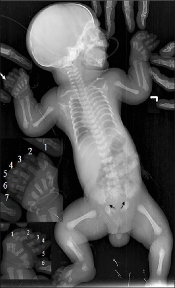 Post natal infantogram showing narrow thorax with short ribs, disproportionate dwarfism, postaxial synpolydactyly on right side and hexadactyly on left side (white arrow and inner small images), clubbed lower ends of both femur and proximal ends of both tibia and ulna, high placed both the clavicles, pelvic dysplasia with low iliac wings and spur like downward projections (small black arrows) at the medial and lateral aspects of the acetabulae.