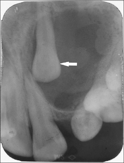 Intraoral periapical radiograph of maxillary left incisor to canine region reveals unilocular radiolucency with impacted maxillary lateral incisor on the left side (arrow).