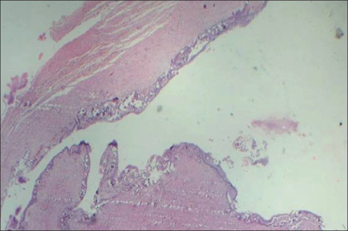 Hemotoxylin and Eosin (4×) stained tissue exhibits a cyst lining-like epithelium made up of cuboidal epithelial cells showing encapsulation.