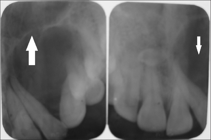 Intraoral periapical radiograph of the region from maxillary left incisor to the canine region unilocular radiolucency with sclerotic border (white arrow).