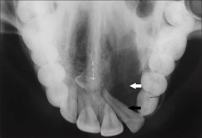 Maxillary occlusal view reveals unilocular radiolucency with a sclerotic border in relation to the maxillary left central incisor to canine (teeth 21-23) region (white arrow), displaced maxillary left lateral incisor (tooth 22, black arrow), and presence of impacted supernumerary teeth in the midline (dashed arrow).
