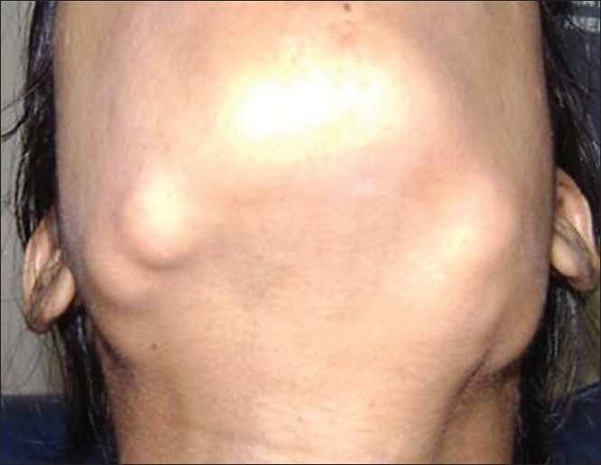 Extraoral osteomas. A 25-year-old female patient with diffuse bilateral swellings on the lower third of face along the mandibular border.