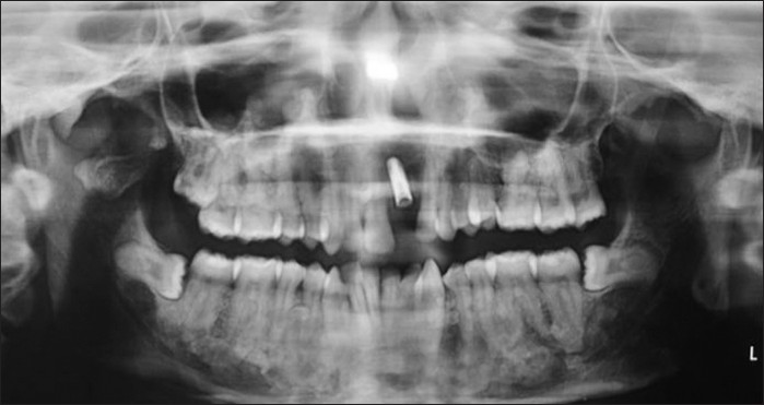 Postoperative radiograph after removal of osteomas, impacted teeth, and implant placement, with respect to tooth 21.