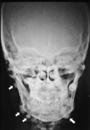 Posteroanterior radiograph shows extra-oral osteomas along the mandible (white arrows).