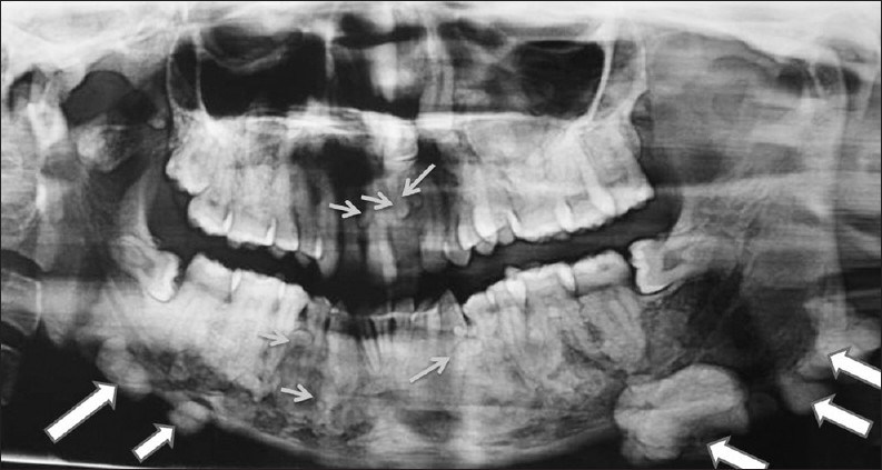 OPG demonstrates impacted teeth 21 and 23, homogenous radiopaque masses over the right and left inferior aspect of the mandible suggestive of osteomas (large arrows). Also multiple small, homogeneous radiopaque masses surrounded by a radiolucent halo could be seen throughout the maxilla and mandible suggestive of complex odontomes (small arrows).Diffuse sclerotic masses are present throughout the body of mandible giving it a mottled appearance