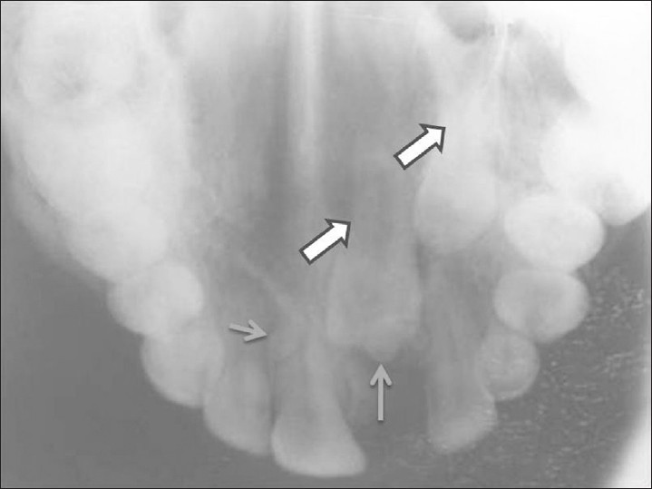 Maxillary occlusal radiograph shows impacted teeth 21, 23 (large arrows) and odontomes (small arrows) in the near vicinity.