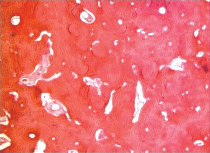 Photomicrograph shows the presence of compact lamellar bone with haversian canal, lacunae, histiocytes and reversal and resting lines suggestive of osteoma. (Hematoxylin-Eosin stain 10×).