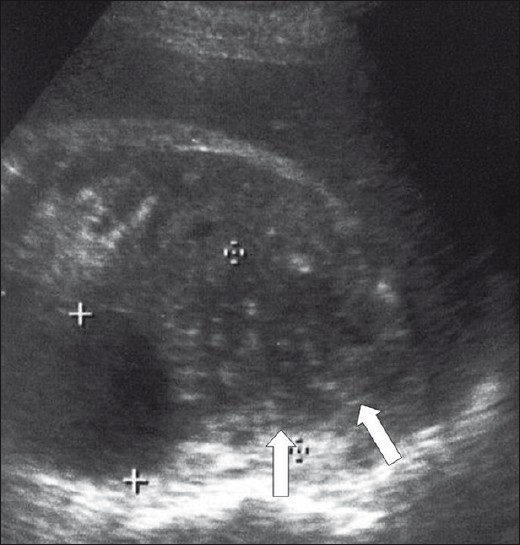 Gray-scale longitudinal image of the right kidney shows a hypoechoic mass (arrows) measuring approximately 5 cm. There is an anechoic cortical cyst beside this lesion.