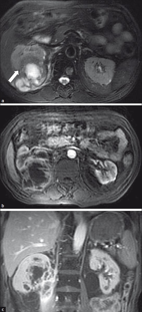 (a) T2-weighted MRI reveals a right renal parenchymal mass (arrow) located posteriorly with peripheral hypointense solid and central hyperintense cystic component and extension to the paraspinal/pernephric region. (b) After gadolinium administration, axial image shows that peripheral solid component and septa formations of lesion enhance earlier but less than the surrounding renal parenchyma, suggesting malignancy. (c) Coronal image shows septal enhancement and extension of the right renal mass into the psoas muscle. There is no extension into the renal vein.