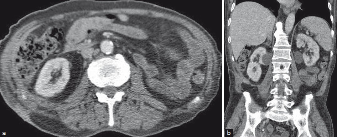 Six months after the first presentation of the patient, the CT examination conducted after administration of iodinated contrast agent yielded complete resolution of the right renal mass on (a) axial and (b) coronal images.