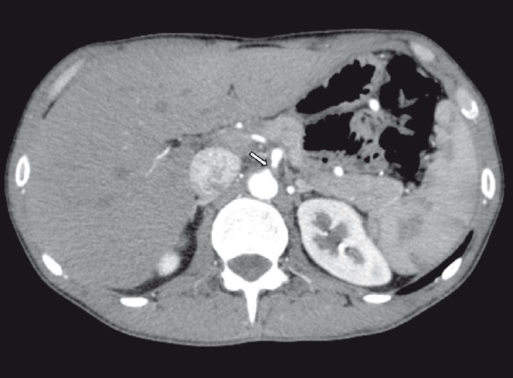 Axial CTA shows compression of the celiac axis by the median arcuate ligament (arrow).