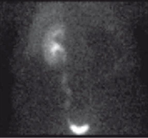 Image from a mercapto acetyl tri glycine (MAG3) scan shows absence of blood flow and function in the left kidney. The right kidney is normal.