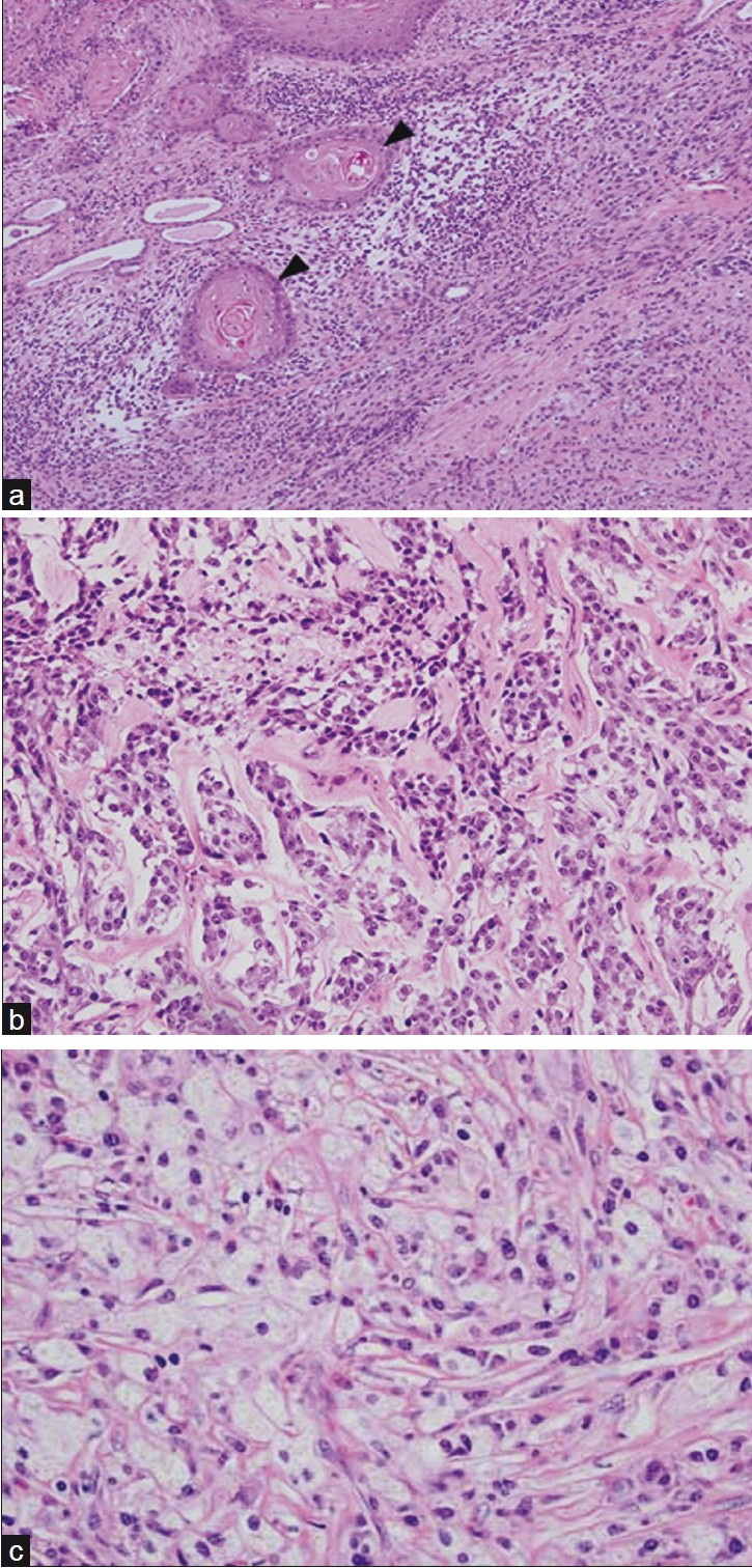 (a) Photomicrograph (10×, hematoxylin and eosin) illustrates several squamous pearls (arrowheads) of a moderately differentiated, keratinizing squamous cell carcinoma “colliding” with spindled osteosarcoma cells. (b) Photomicrograph (20×, hematoxylin and eosin) shows spindled to polyhedral tumor cells arranged in cords and interweaving fascicles. Ramifying throughout the cords of tumor cells are wisps of pale pink, homogenous chondro-osseous matrix. (c) Photomicrograph (40×, hematoxylin and eosin) demonstrates characteristic lipid-laden foamy macrophages or “xanthoma cells”, the hallmark of xanthogranulomatous pyelonephritis.