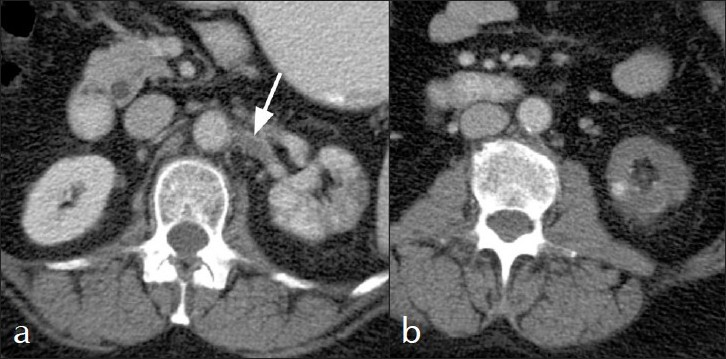 Contrast-enhanced CT scan of the abdomen demonstrates (a) left renal artery thrombus (arrow) and (b) heterogenous cortical enhancement and wedge shaped cortical hypodensities in the lower pole of the left kidney.