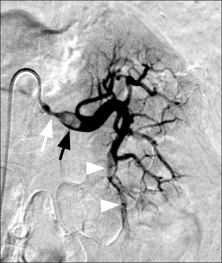 Selective left renal angiogram shows a proximal high-grade stenosis (white arrow) with a thrombus in the post stenotic segment of the renal artery (black arrow) and several emboli in the inferior segmental renal branches (arrowheads).