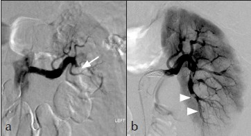 (a): After stent placement the renal artery is widely patent with improved blood flow in the renal artery. Stent placement had resulted in distal embolization of thrombus into the inferior renal branch (arrow). (b) Renal angiogram following 22 hours of thrombolysis showed small residual emboli in the inferior branches (arrowheads) with significant improvement of the cortical perfusion.