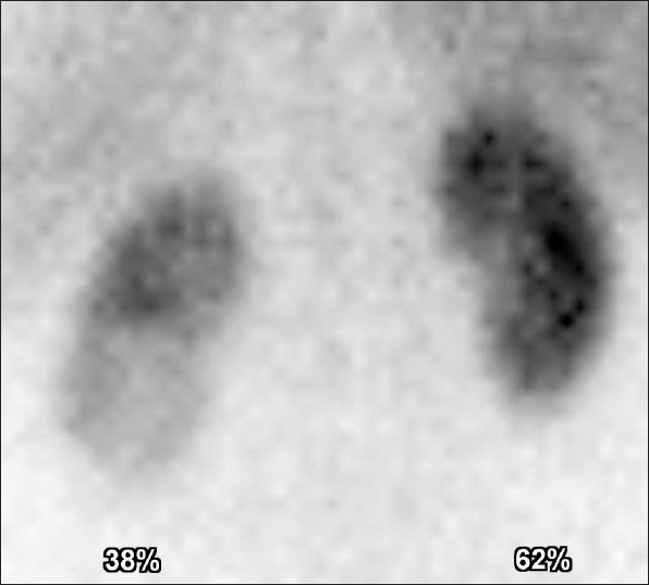 Renal isotope scan one month later revealed slightly reduced cortical uptake in the lower pole of the left kidney with borderline reduced split renal function of 38%.