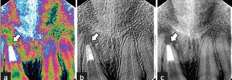 Various RVG images (a) Pseudo color RVG image shows obturation in the apical third of the root canal and resorption of the root apex. (b) 3D RVG image of a periapical lesion and root canal obturation. (c) Normal RVG image of a periapical lesion and root canal obturation.