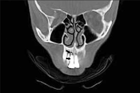 CT image shows root canal obturation and extrusion of the root canal sealer in the periapical area of the maxillary central incisor (Black arrows).