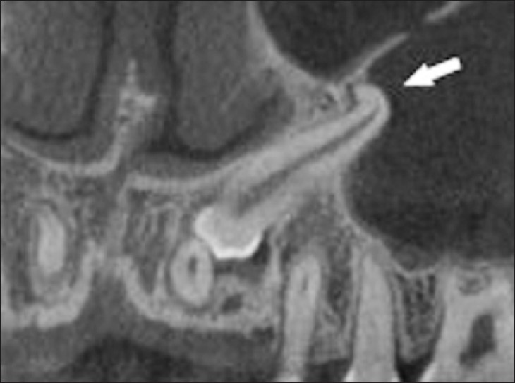 Cone beam CT image shows a sagittal view of impacted maxillary canine with severe dilaceration (arrow)