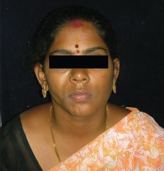 A 28-year-old female patient with facial asymmetry and sunken right cheek.