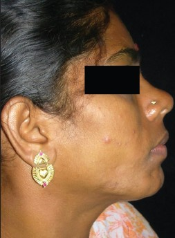 Right profile view of the patient shows the atrophic region with pigmentation.