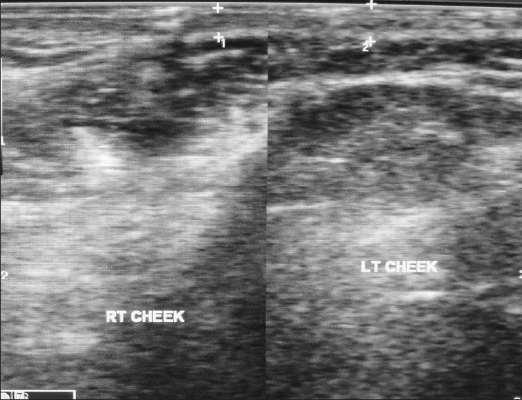 Ultrasound image reveals normal facial anatomy on the left side and altered echogenicity on the right cheek at the subcutaneous and massetric layer.