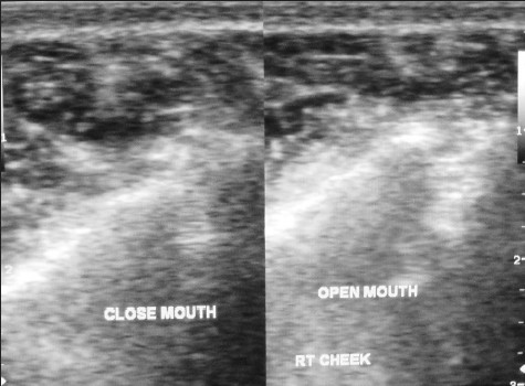 Ultrasound image of the affected side, allows measurement of muscle thickness in both open and closed mouth positions.