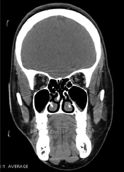 Coronal CT shows subcutaneous atrophy of fat on the right side.