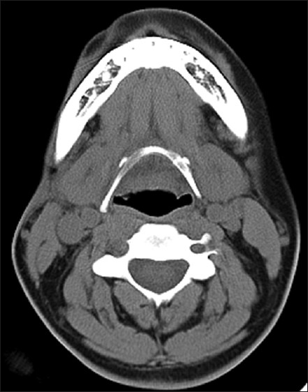 Axial CT demonstrates subcutaneous atrophy at the level of the right mandible.