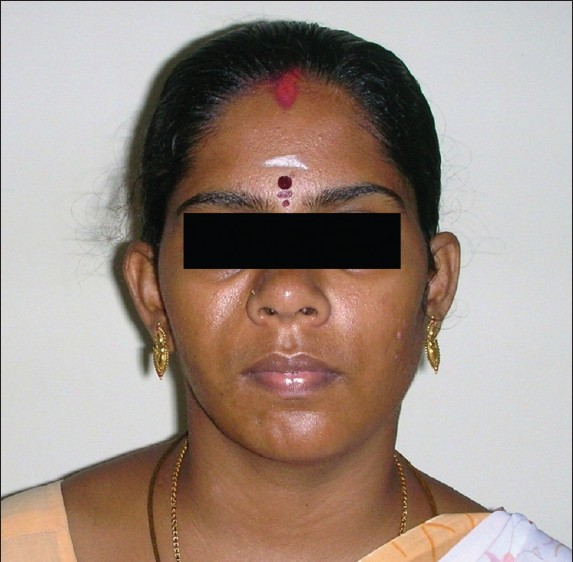 Patient's face after soft tissue reconstruction.