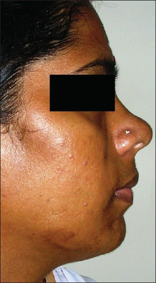 Patient's right profile after soft tissue reconstruction.