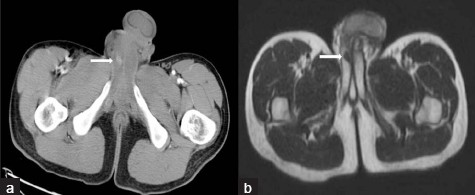 Right cavernosal artery pseudoaneurysm in a 19-year-old boy with right hip pain. (a) CT and (b) MRI images at the level of lower pelvis shows blotches of contrast (white arrows) in shaft of the penis on the right side.