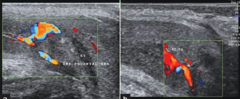 Right cavernosal artery pseudoaneurysm. (a) Color doppler images shows turbulence of flow in the pseudoaneurysm at the root of the penis. (b) Postembolization color Doppler image shows complete absence of flow in the pseudoaneurysm.