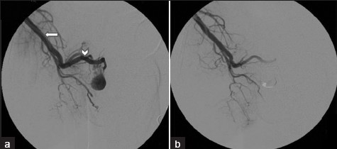 (a) Right internal iliac artery angiogram shows internal pudental artety (white arrow) with pseudoaneurysm filling through right cavernosal artery (arrow head). (b) Postembolization microcatheter angiogram shows complete obliteration of pseudoaneurysm.