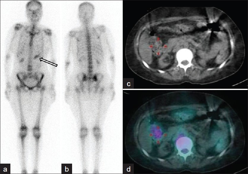 Whole body gallium scintigraphy (a) anterior and (b) posterior images show diffuse skeletal tracer uptake. Focal tracer uptake seen in the region of left kidney on anterior images (arrow). (c) Axial CT image shows focal tracer uptake corresponding to bowel uptake of gallium, better appreciated on (d) fused SPECT CT image.