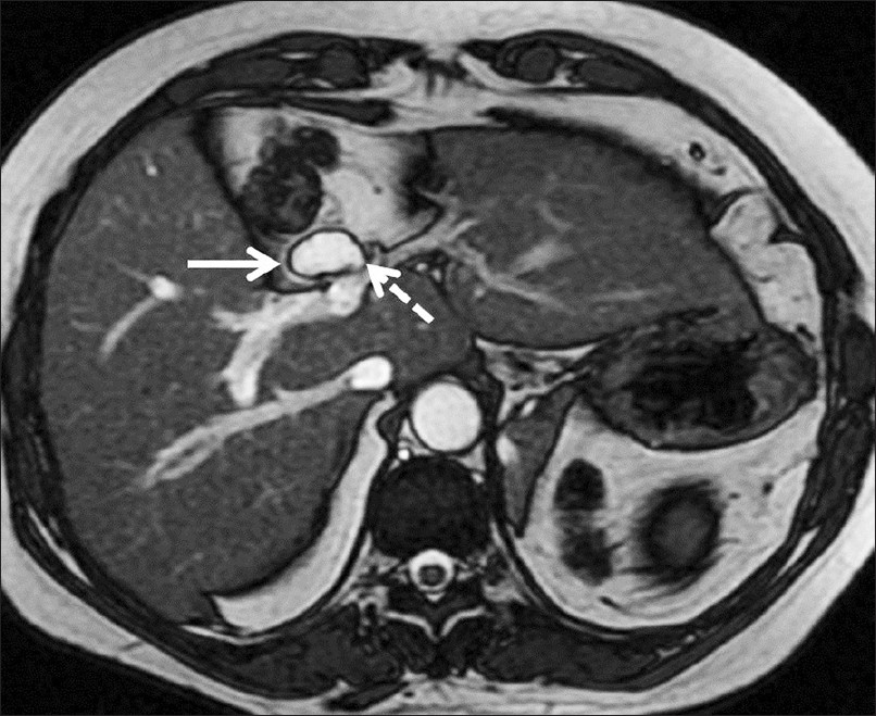 Axial fast imaging employing steady-state acquisition image, shows a small cystic lesion (white arrow) along the course of the bed of the gallbladder, in proximity to the bile duct (dashed arrow).