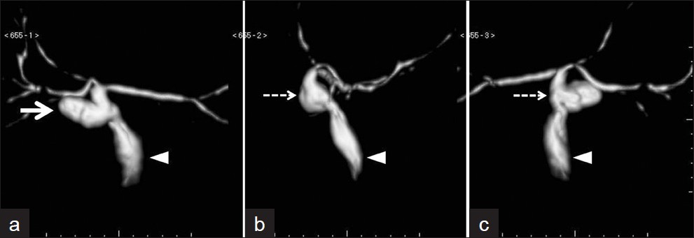 Volume rendering technique images: (a) Front view; (b) lateral view; and (c) rear view show a small dysmorphic cystic dilatation (white arrow), which shows extensive communication with the bile duct (dashed arrow). The common bile duct is dilated (arrowhead), assuming the function of bile storage.