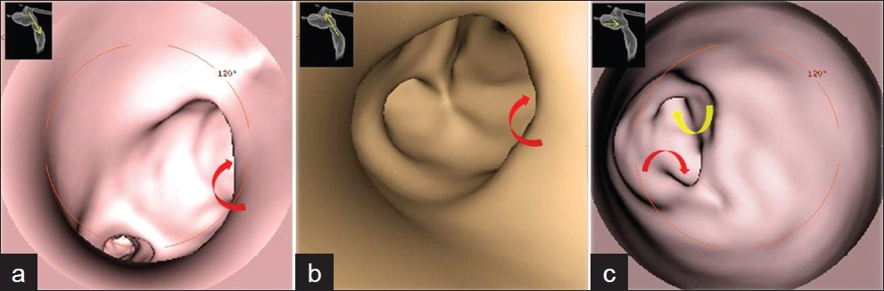 Images of virtual endoscopy of the biliary tract. (a) Cranial endoscopic view, from the common hepatic duct into the common bile duct. We can appreciate the wide communication between the bile duct and cystic dilatation (red curved arrow). (b) Caudal view from the common bile duct into the common hepatic duct. Input cystic dilatation (curved arrow red). (c) View from the bottom of the cystic dilatation, into the common bile duct; you can well appreciate the openings, respectively, of the common hepatic duct (curved arrow yellow) and the common bile duct (arrow red curve).