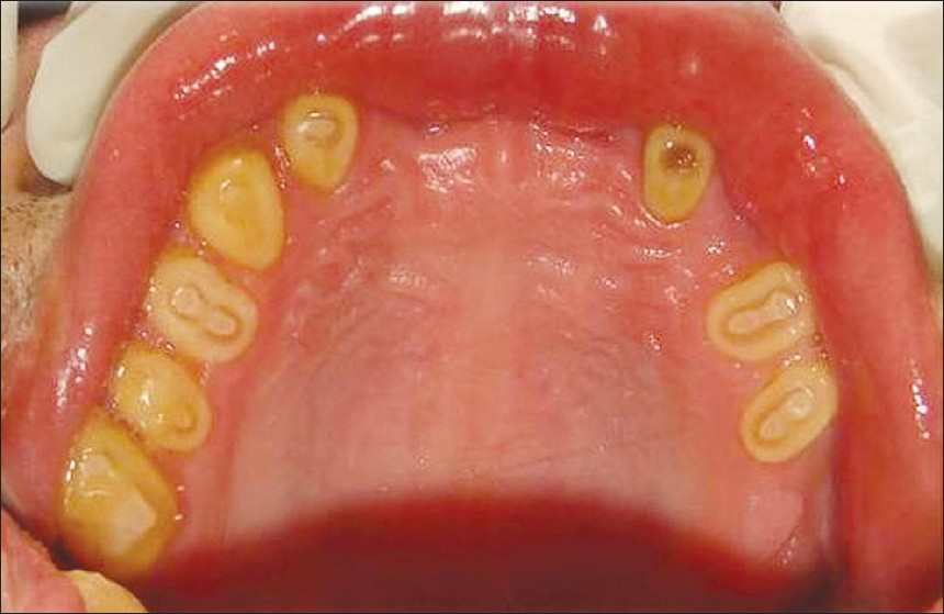 Intra-oral photograph shows malformed dentition with pulpal exposure of all teeth in the maxillary arch.