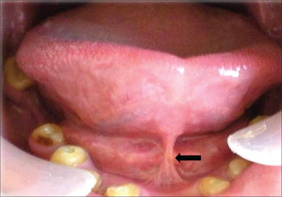 Intra-oral photograph shows partial ankyloglossia (arrow).