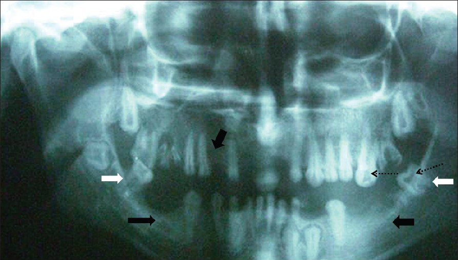 Orthopantomograph shows multiple unerupted teeth and missing permanent tooth germs (black arrow), short roots (white arrow), and enlarged pulpal chambers (dashed arrow).