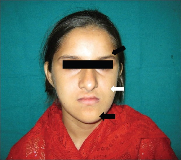 Extra-oral photograph shows dolicocephalic, hypoplastic maxilla (white arrow), with anti-mongoloid features (black arrow).