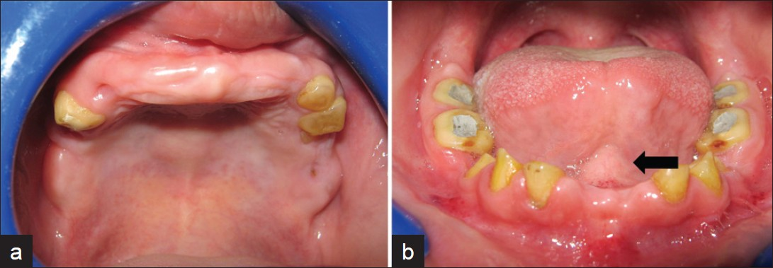 (a) Intra oral photograph of the maxillary arch shows multiple missing teeth (b) Intra oral photograph shows ankyloglossia (arrow), widely spaced, discolored, and malformed teeth.