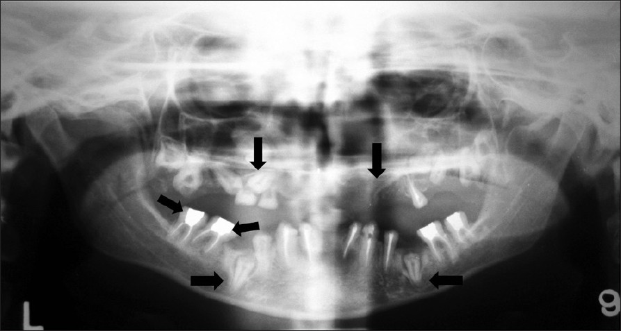 Orthopantomograph shows multiple impacted teeth, multiple missing permanent tooth germs, retained teeth (arrow), short roots (arrow), and enlarged pulp chambers (arrow).