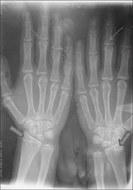 Hand-wrist radiograph shows incomplete capping of the epiphysis of the mid phalanx (small arrow) and incomplete fusion of the epiphysis and diaphysis of the radius (large arrow).